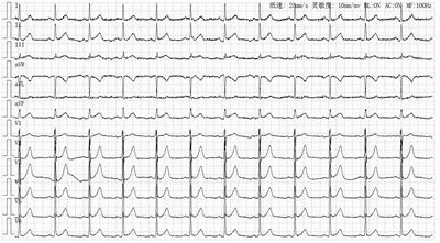 Case report: Implantable cardioverter-defibrillator implantation with optimal medical treatment for lethal ventricular arrhythmia caused by recurrent coronary artery spasm due to tyrosine kinase inhibitors